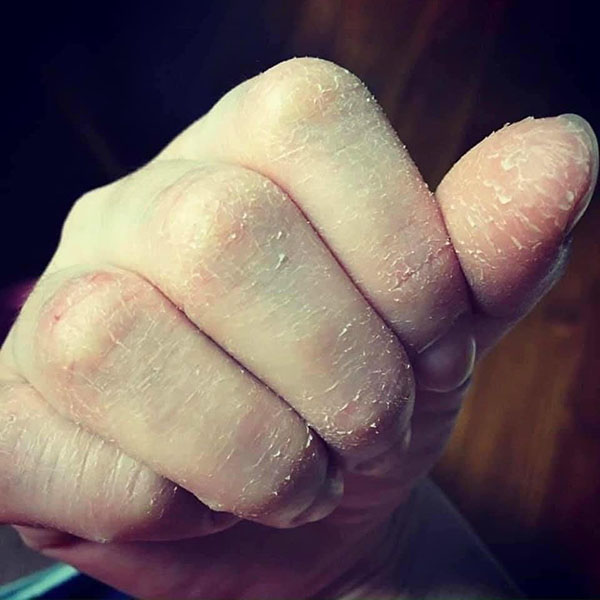 Nứt nẻ da tay, da chân, thậm chí gây chảy máu đau đớn cho người bệnh